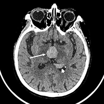 Case report: Ventricular primary central nervous system lymphoma with partial hypointensity on diffusion-weighted imaging